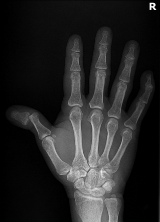 Thumb interphalangeal dislocation | Radiology Case | Radiopaedia.org