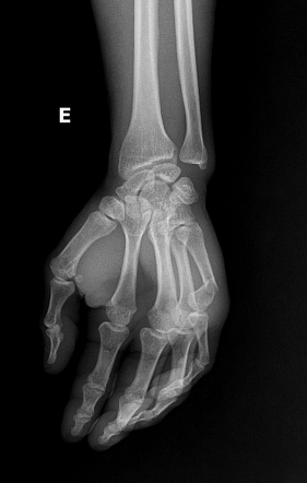 Boxer Fracture Radiology Case Radiopaedia Org