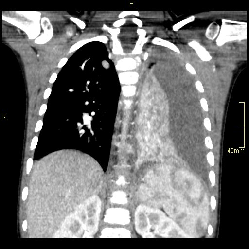 Necrotizing pneumonia | Image | Radiopaedia.org