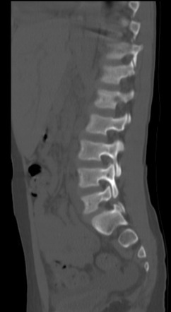 Spondylolysis and spondylolisthesis | Radiology Case | Radiopaedia.org