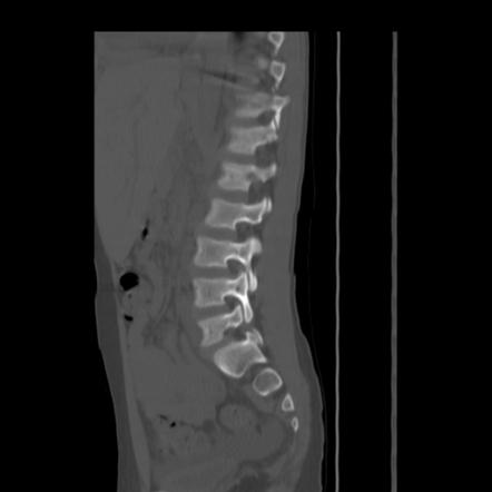 Viewing playlist: CHR 663L Lesson 6: Spondylolysis & Spondylolisthesis ...