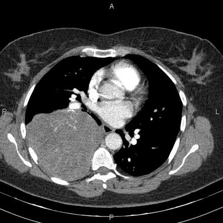 Malignant solitary fibrous tumour of the pleura | Radiology Case ...