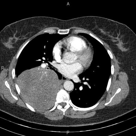 Secondary involvement of the pleura with lymphoma | Radiology Reference ...