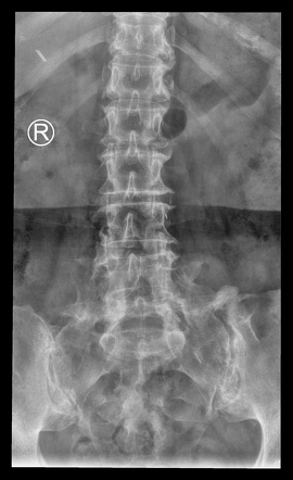 Posterolateral lumbar fusion | Radiology Case | Radiopaedia.org