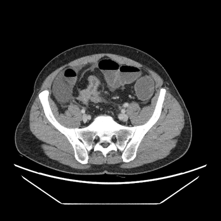 Bowel obstruction due to metastatic sigmoid tumor | Radiology Case ...