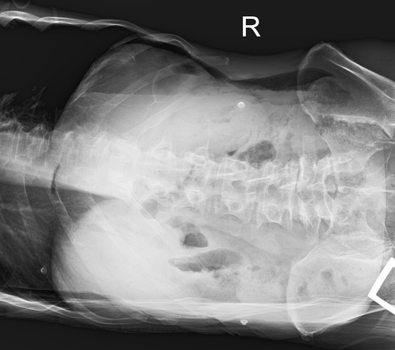 Duodenal perforation | Radiology Case | Radiopaedia.org