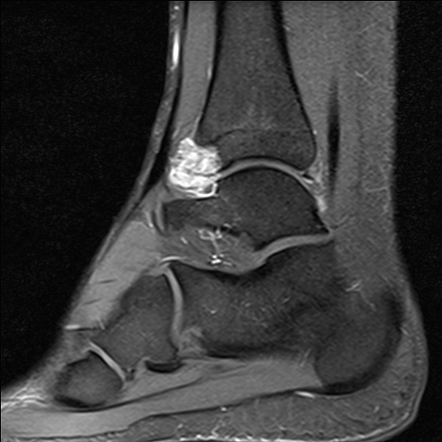 Diffuse intra-articular tenosynovial giant cell tumor - ankle | Image ...