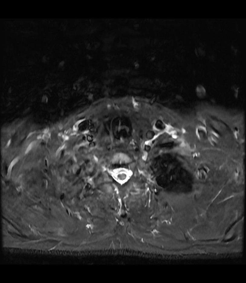 Calcific Tendinitis Of The Longus Colli | Image | Radiopaedia.org