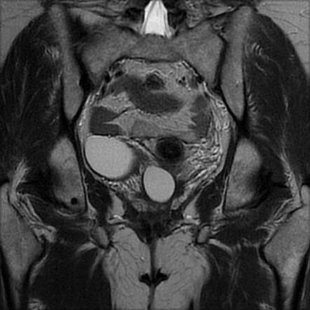 Gartner duct cyst | Image | Radiopaedia.org