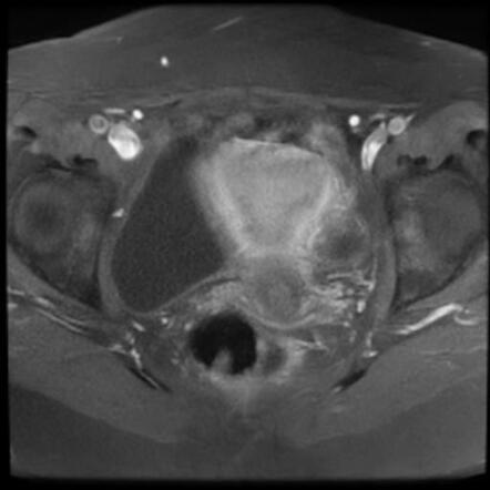 Gartner duct cyst | Image | Radiopaedia.org