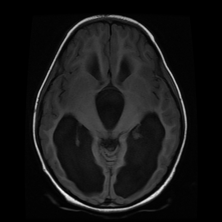 Blake pouch cyst | Radiology Case | Radiopaedia.org