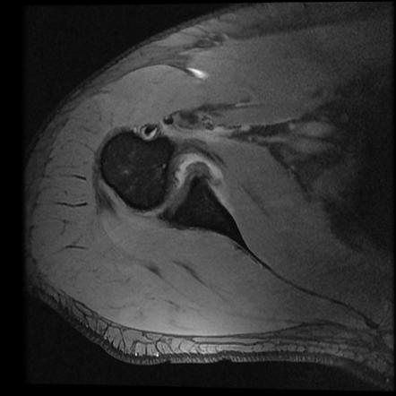 Recent anterior dislocation of the right shoulder and posterior ...