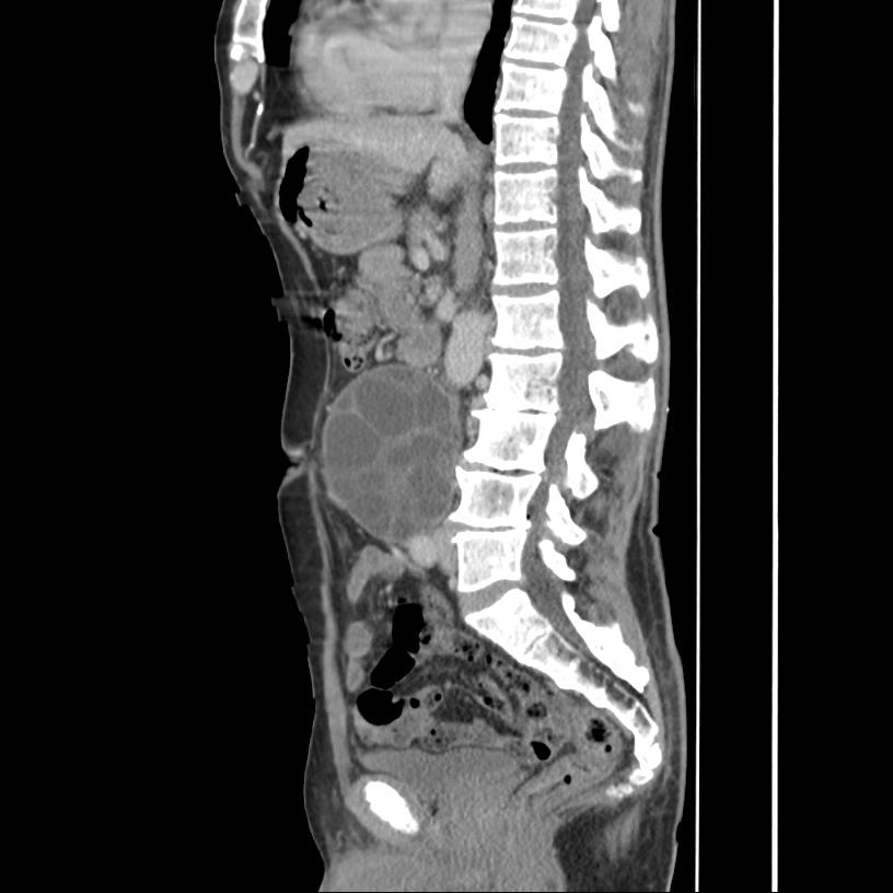 Retroperitoneal hydatid cyst | Image | Radiopaedia.org