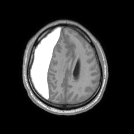 Subdural Haematoma Late Subacute Radiology Case Radiopaedia Org