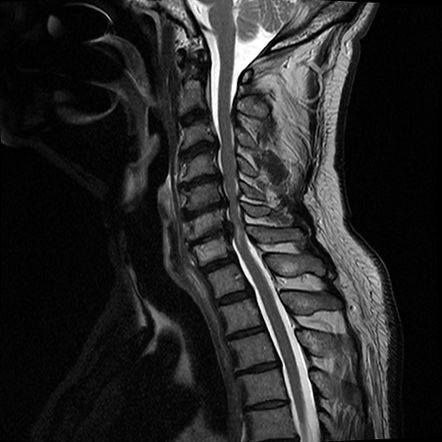 Compressive myelopathy | Radiology Case | Radiopaedia.org