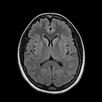 Optic neuritis | Image | Radiopaedia.org