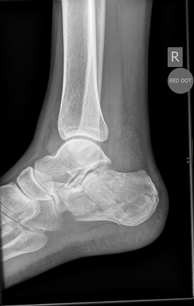 Lover's fracture | Radiology Reference Article | Radiopaedia.org