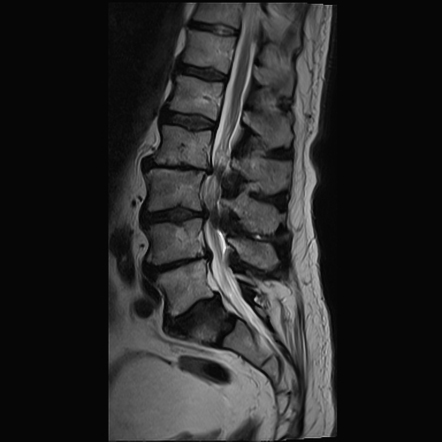 Butterfly vertebra - S1 | Image | Radiopaedia.org