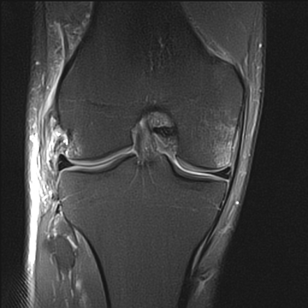 Posterolateral corner injury of the knee | Radiology Reference Article ...