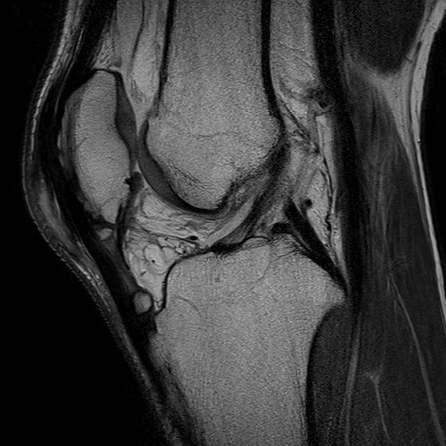 Lateral collateral ligament complex and posterolateral corner injury ...