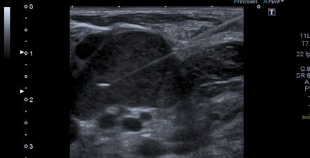 Ultrasound-guided biopsy | Radiology Reference Article | Radiopaedia.org