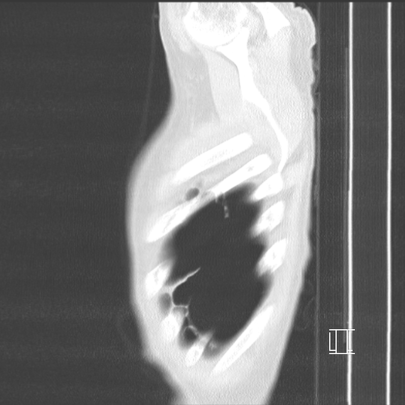 Loculated pneumothorax Image