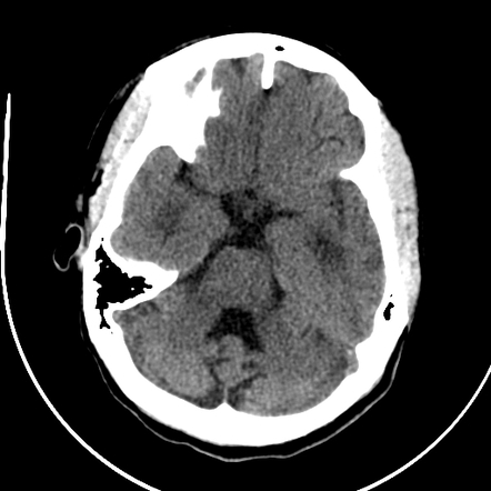 Uremic encephalopathy | Image | Radiopaedia.org