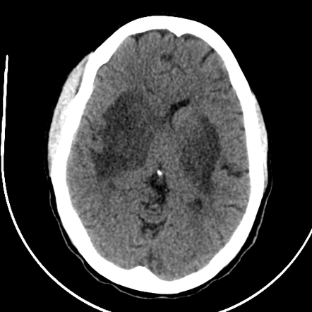 Uraemic encephalopathy | Radiology Case | Radiopaedia.org