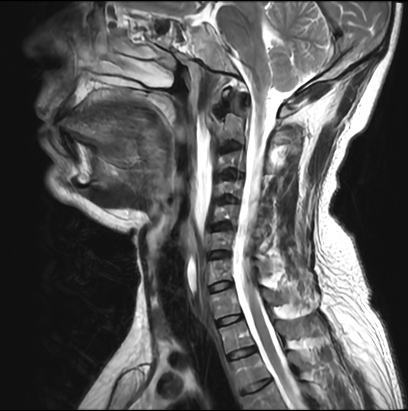 Calcific Tendinitis Of The Longus Colli | Image | Radiopaedia.org