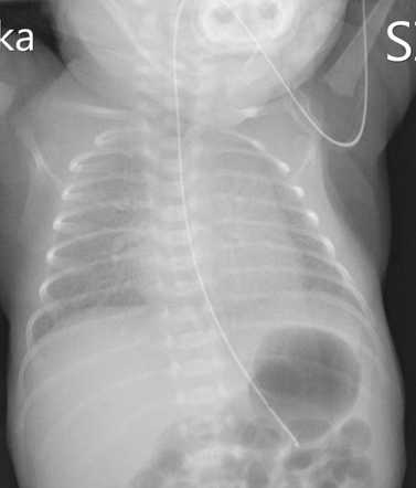 Respiratory Distress Syndrome 