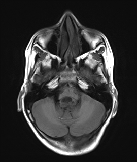 Ependymoma | Image | Radiopaedia.org