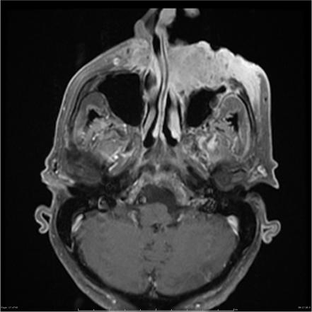 Head And Neck Squamous Cell Carcinoma (overview) 