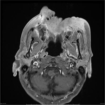 Squamous cell carcinoma of maxilla | Radiology Case | Radiopaedia.org