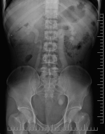 Ureteric calculi | Radiology Reference Article | Radiopaedia.org