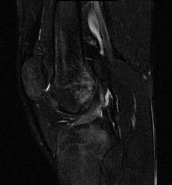 Regional osteopenia | Radiology Reference Article | Radiopaedia.org