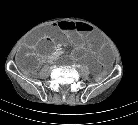 Small bowel obstruction | Radiology Case | Radiopaedia.org