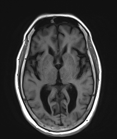 Progressive Supranuclear Palsy | Image | Radiopaedia.org