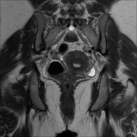 Anterior Rectocele | Image | Radiopaedia.org