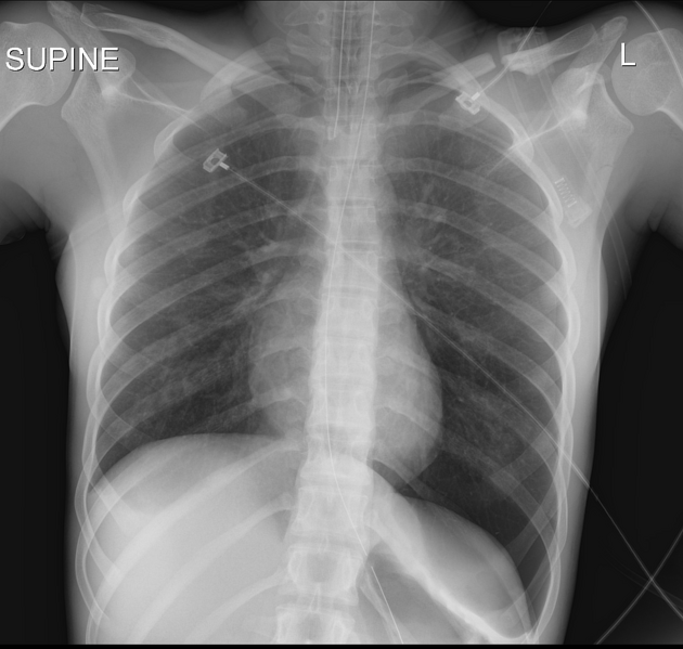 Double diaphragm sign, Radiology Reference Article