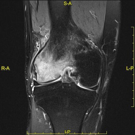 Subchondral Insufficiency Fracture Of The Knee | Radiology Case ...