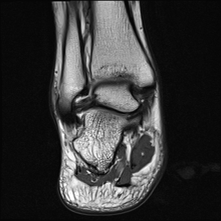 Complete tear of anterior talofibular ligament | Image | Radiopaedia.org