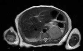 Congenital diaphragmatic eventration | Image | Radiopaedia.org