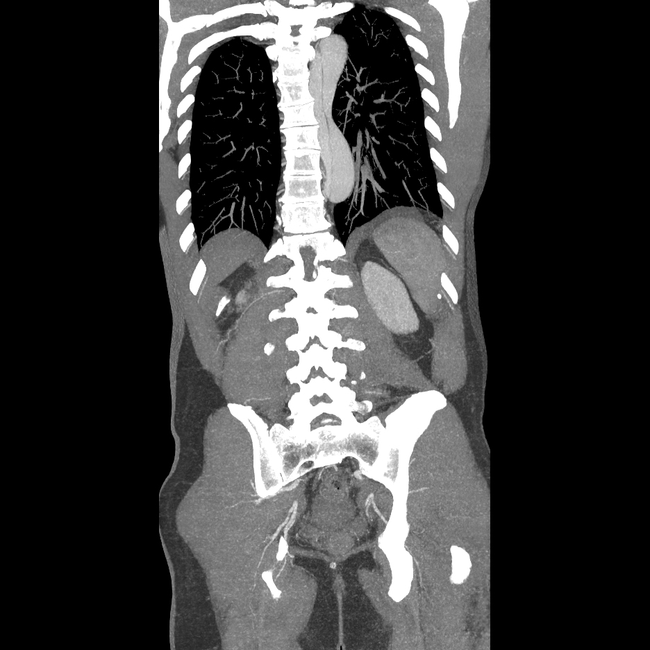 Stanford Type B Aortic Dissection | Image | Radiopaedia.org