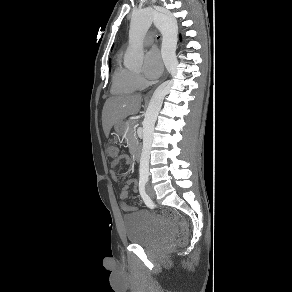 Stanford Type B Aortic Dissection | Image | Radiopaedia.org