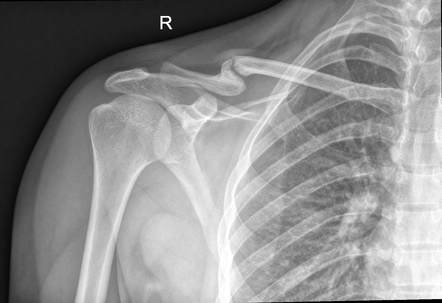 Nonunion clavicle fracture | Radiology Case | Radiopaedia.org