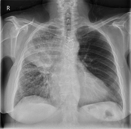 Lung cancer with lymphangitis carcinomatosis | Radiology Case ...