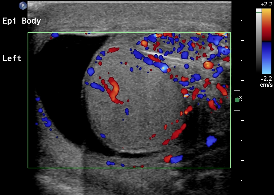 Орхоэпидидимит. Хронический эпидидимит на УЗИ. Хронический орхоэпидидимит на УЗИ. О Стрый эпидимит на УЗИ.