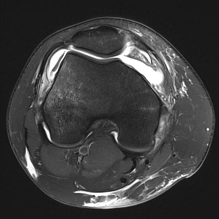 Medial Collateral Ligament Avulsion | Image | Radiopaedia.org