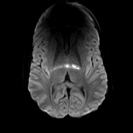 Periorbital Cellulitis With Intracranial Extension Image Radiopaedia Org