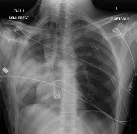 Pulmonary contusion after gunshot wound | Radiology Case | Radiopaedia.org